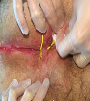 Anorectal treatment in modasa