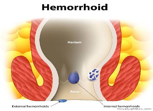Best Piles Hospital in Gujarat