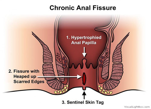 Anorectal Treatment in Modasa