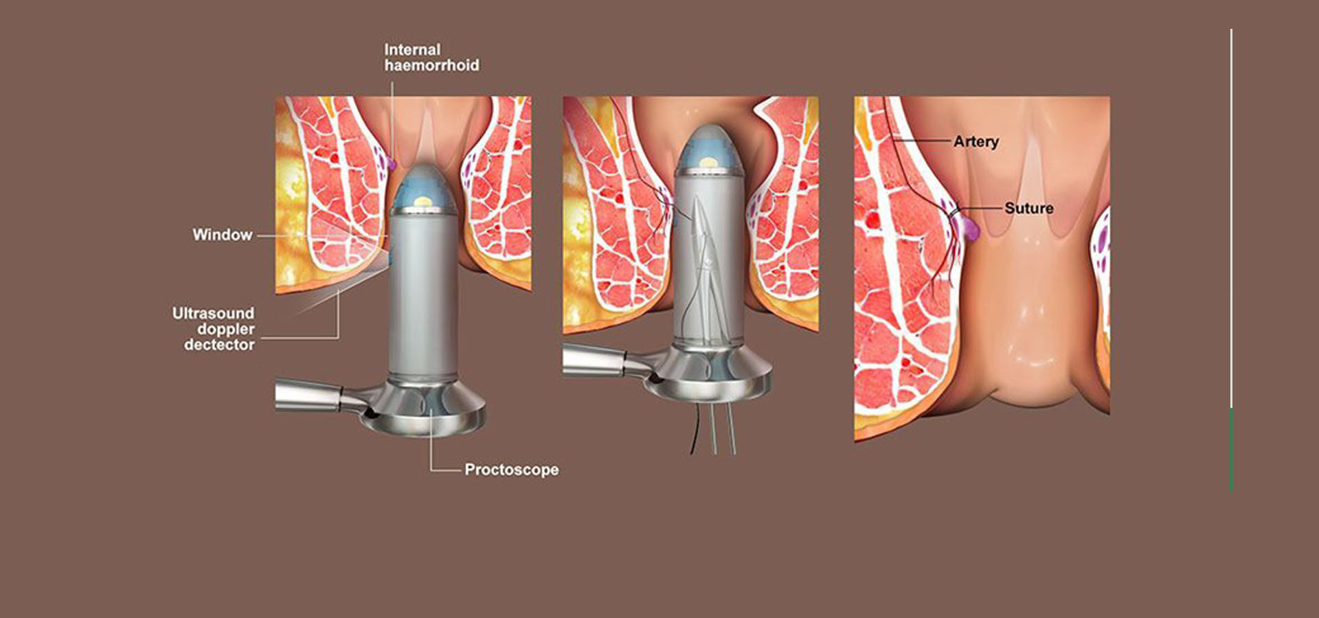 Without Operation Piles Treatment in Modasa